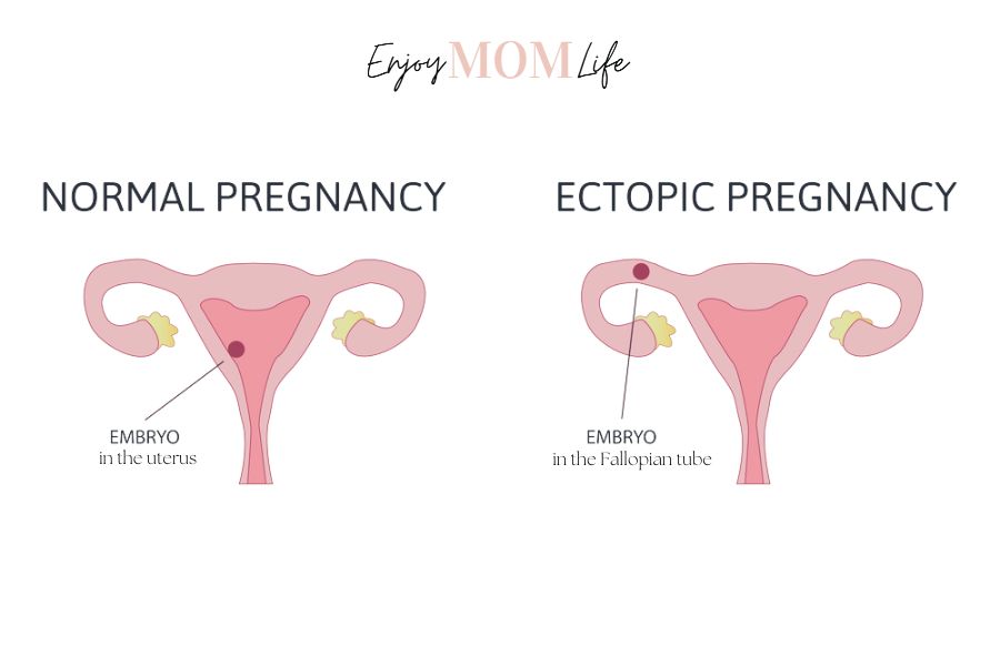 ectopic pregnancy vs miscarriage